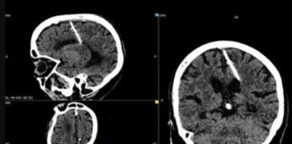 Mulher descobre que tem uma agulha enfiada no cérebro, e isso nem é o pior