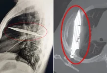 Oito anos com uma faca enterrada no peito e não sabia