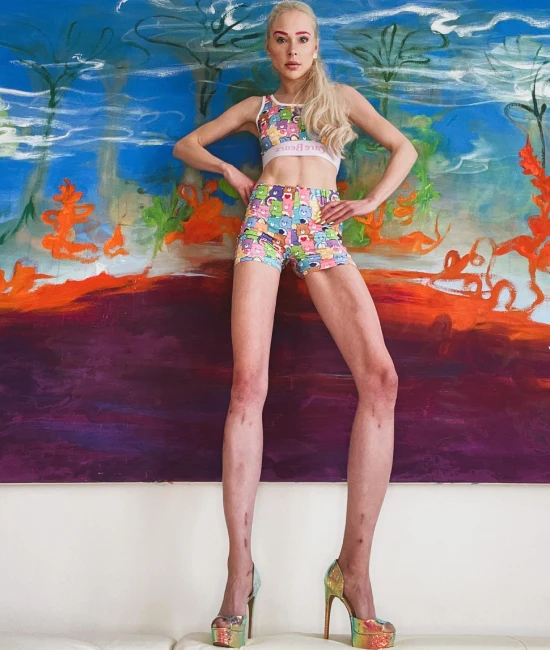 Leg lengthening surgery | Bizarro | cirurgia, curioso, estética, estranho