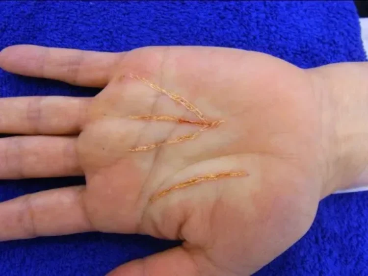 Palm line surgery | Bizarro | cirurgia, curioso, estética, estranho