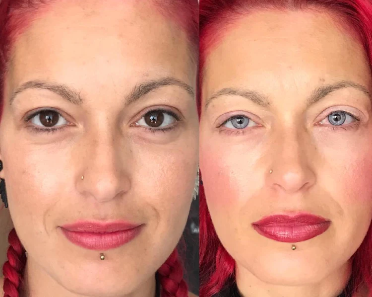 Keratopigmentation | Bizarro | cirurgia, curioso, estética, estranho